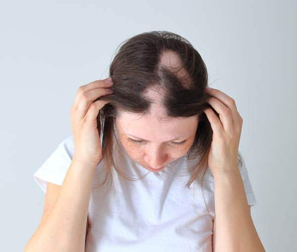 alopecia