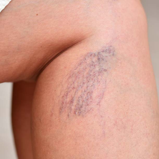 Angiologia | Mastroluca Medical House Roma