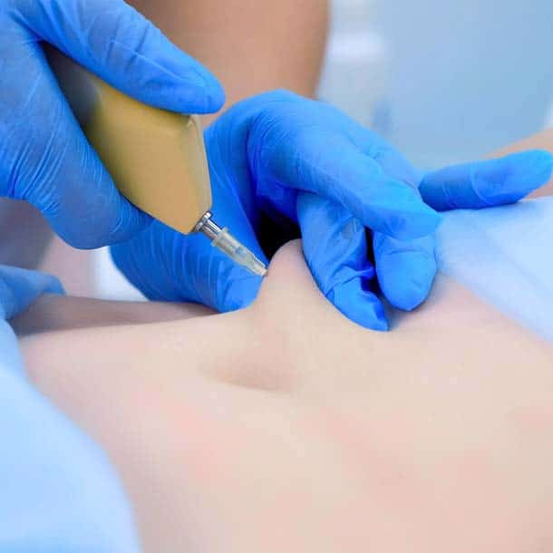 Carbossiterapia | Mastroluca Medical House Roma