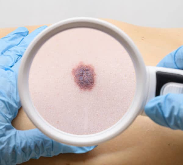 Epitelioma / basalioma