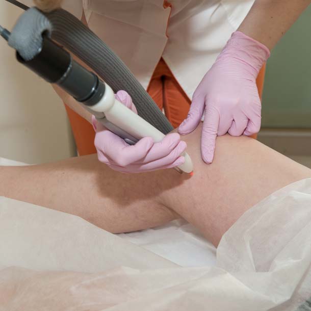 Laser Capillari | Mastroluca Medical House Roma